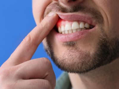 man with periodontal gum problems